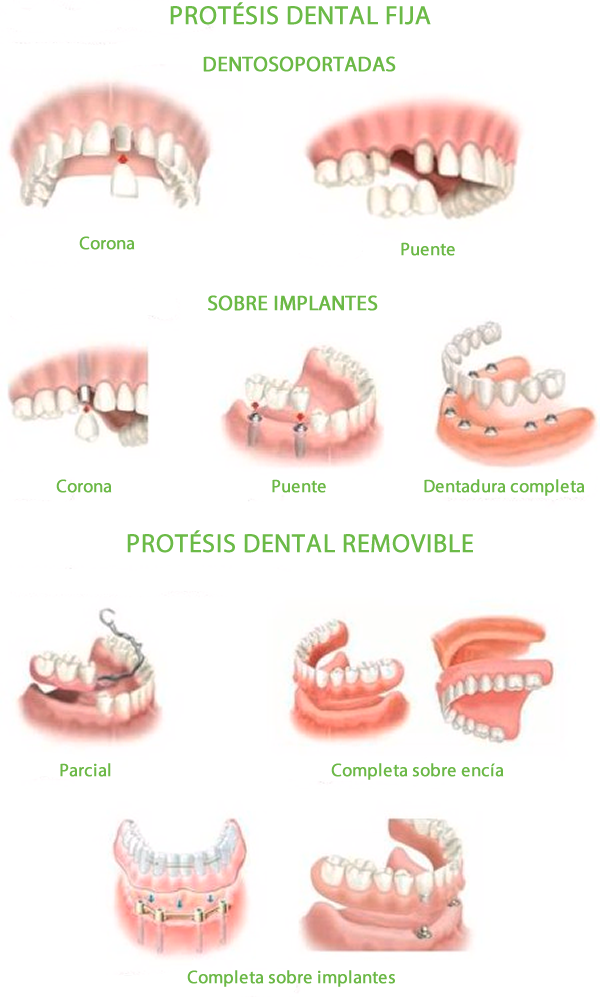 Distintos tipos de prótesis dentales Beniaján