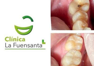 clinica dental la fuensanta beniajan Odontología General