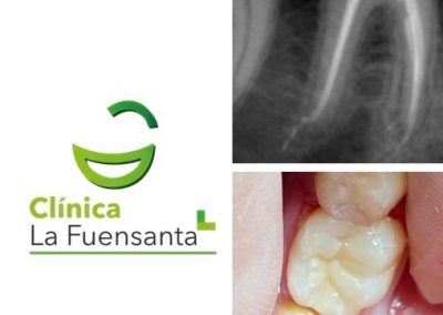 Clínica dental Los Garres - Endodoncia
