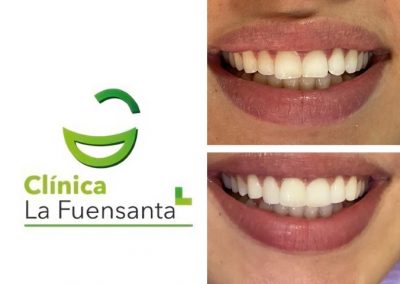 Clínica dental Los Garres - Estética Dental
